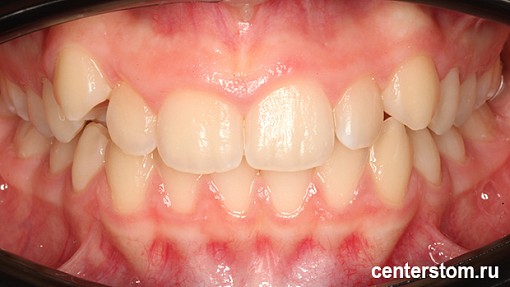 Как мы мягко расширили челюсти и освободили место для клыков, чтобы создать идеальную улыбку