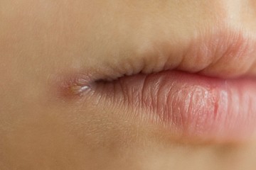 Заеды в уголках рта (ангулярный хейлит): почему появляются и как лечить