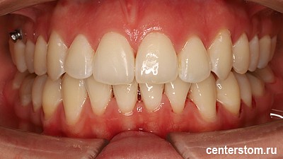 Фото после Мы исправили «детскую» проблему прикуса у взрослой пациентки