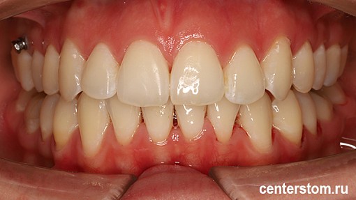 Мы исправили «детскую» проблему прикуса у взрослой пациентки