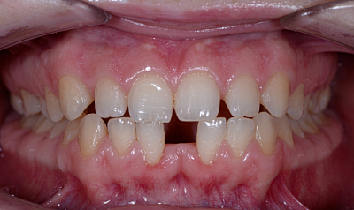 Фото до «Редкие зубы» - коррекция увеличенных межзубных промежутков и крупной диастемы между передними нижними резцами