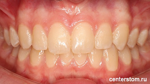 История улыбки: как мы помогли юной пациентке исправить положение клыка без брекетов и удаления зубов