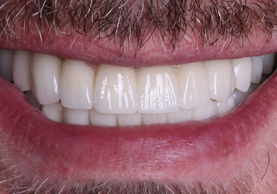 Фото после Тотальное восстановление зубов по протоколу All-on-8 