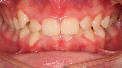 Фото до Защита детских зубов от стирания путем коррекции скученности у пациентки 11 лет