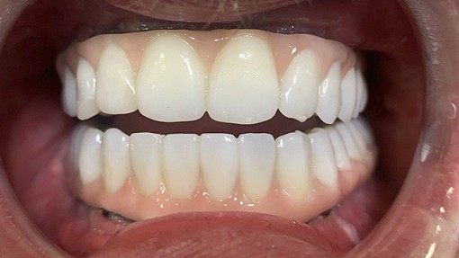 Полное восстановление всех зубов по протоколу All-on-8 в условиях седации для пациента с боязнью стоматологов