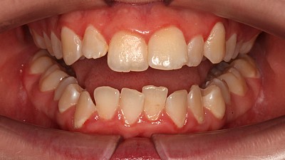 Фото до Командная работа: ортодонт и гнатолог на страже здоровья все полости рта