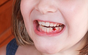 Кровотечение из лунки зуба