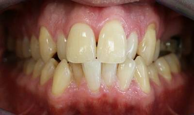 Фото до Мезиальная окклюзия, скученное положение зубов нижней челюсти